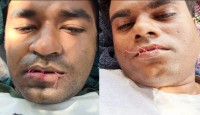 অস্ট্রেলিয়ার দ্বীপ কারাগারে বন্দিত্বের প্রতিবাদে দুই বাংলাদেশির মুখ সেলাই